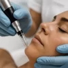Professional microneedling in Orlando